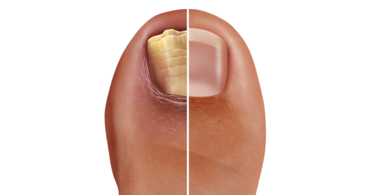 Preventing and treating nail fungus or fungal nail infections