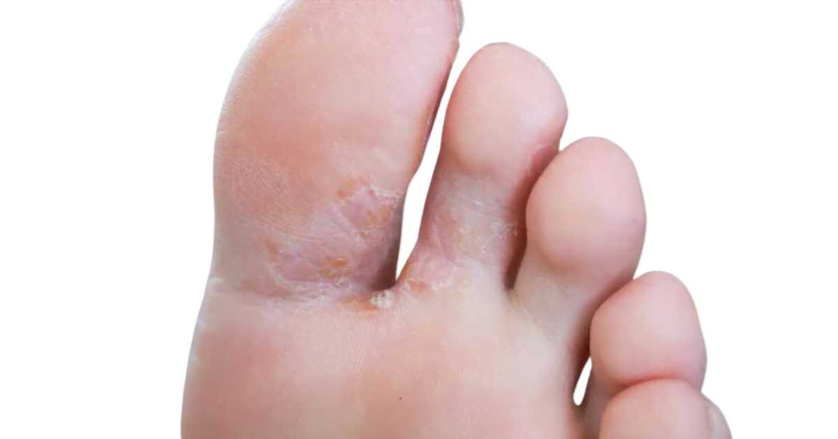 Athlete's Foot (Tinea Pedis): Symptoms and Treatment
